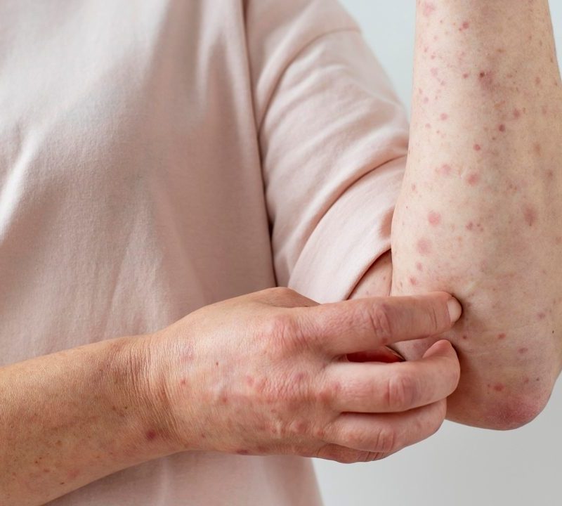 Santo André registra novo caso de mpox; Grande ABC soma seis infecções